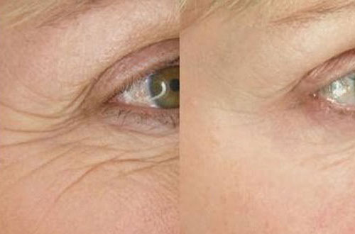 Microneedling1