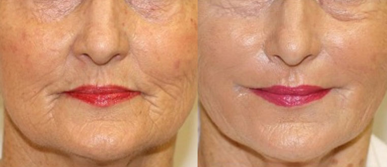 Microneedling3
